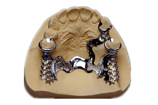 Full Cast Dental Crowns & Bridges